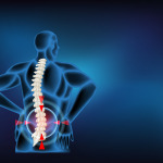 Diagram showing herniated disc in human