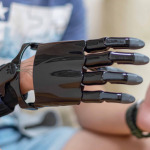 Prosthesis on the arm of a boy