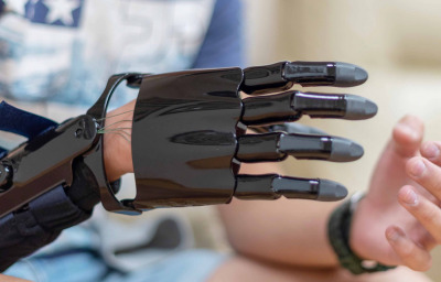 Prosthesis on the arm of a boy