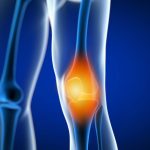 Painful Knee