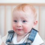 Child with atopic dermatitis