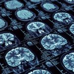 Closeup of X-ray photography of human brain