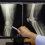 Doctor pointing on the knee problem point on x-ray film. x-ray film show skeleton knee on film.