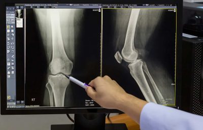 Doctor pointing on the knee problem point on x-ray film. x-ray film show skeleton knee on film.