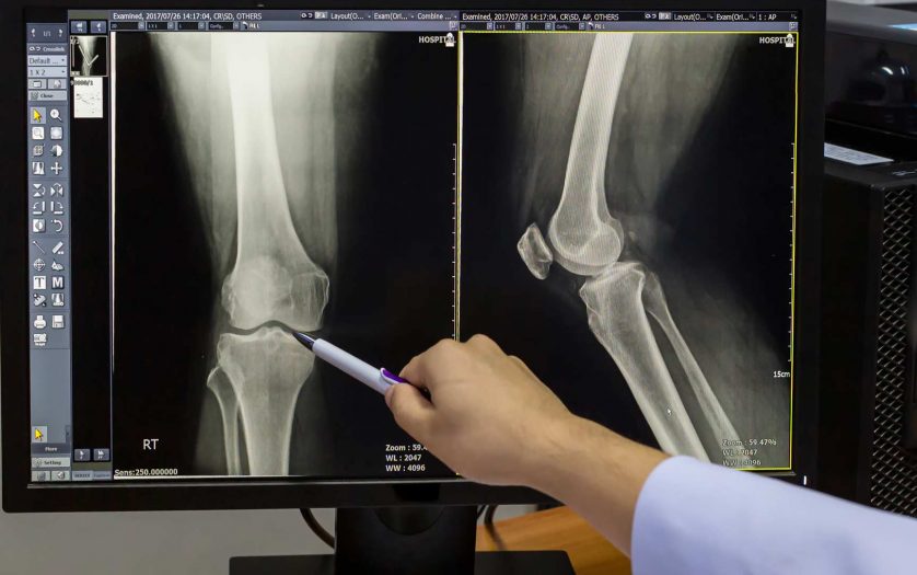 Doctor pointing on the knee problem point on x-ray film. x-ray film show skeleton knee on film.