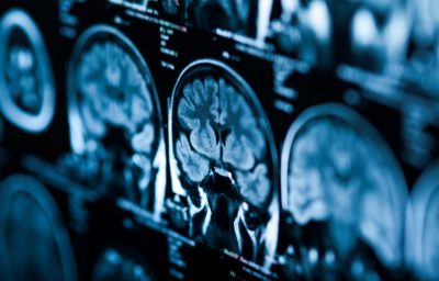 brain Xray